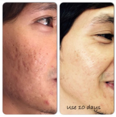 Acne treatment result